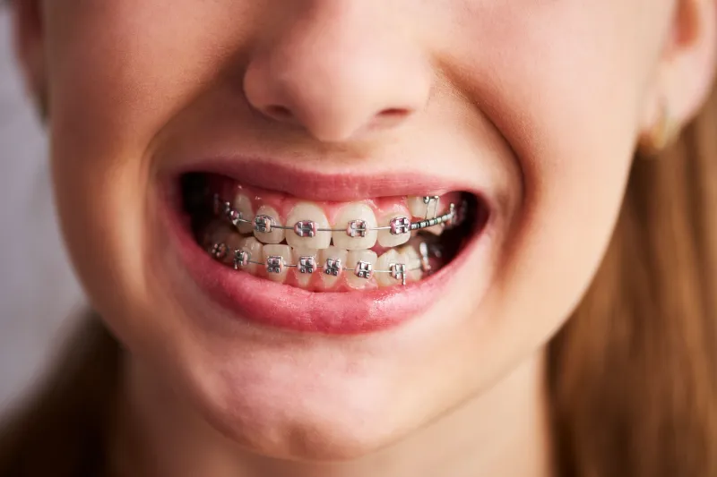 Braces Near You for Safe and Effective Teeth Straightening